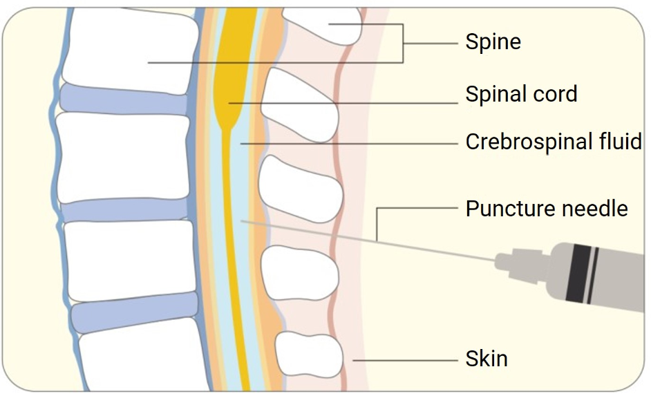 Why Use the Intrathecal Route for CNS Therapy?